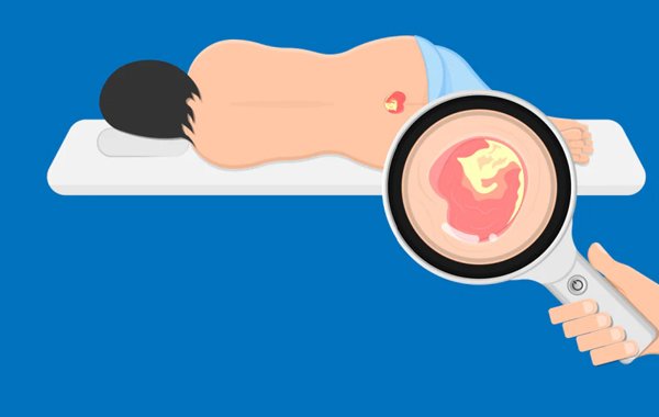 Bed Sores Causes and Prevention