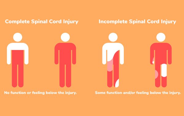 Understanding Different Types & Levels of Spinal Cord Injury